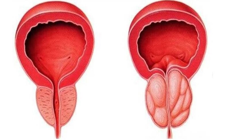 A healthy and inflamed prostate (with prostatitis)