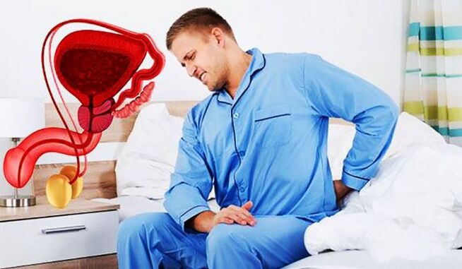 Low back pain caused by prostatitis