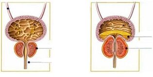 Types and forms of male prostatitis