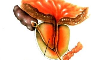 What is male prostatitis
