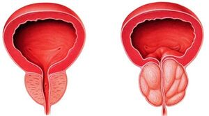 prostatitis