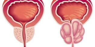 prostatitis