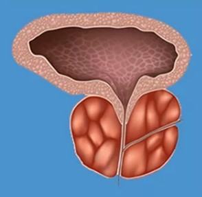 The characteristic signs of prostatitis
