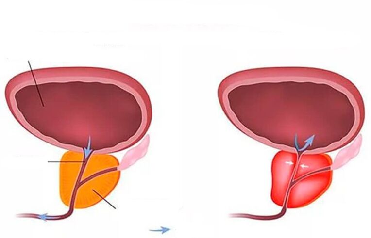Normal and inflamed prostate