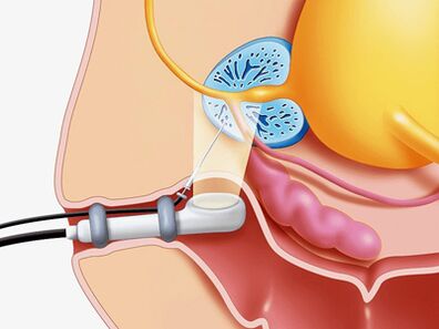 Prostate biopsy