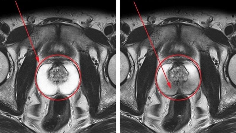Healthy inflamed prostate with chronic prostatitis