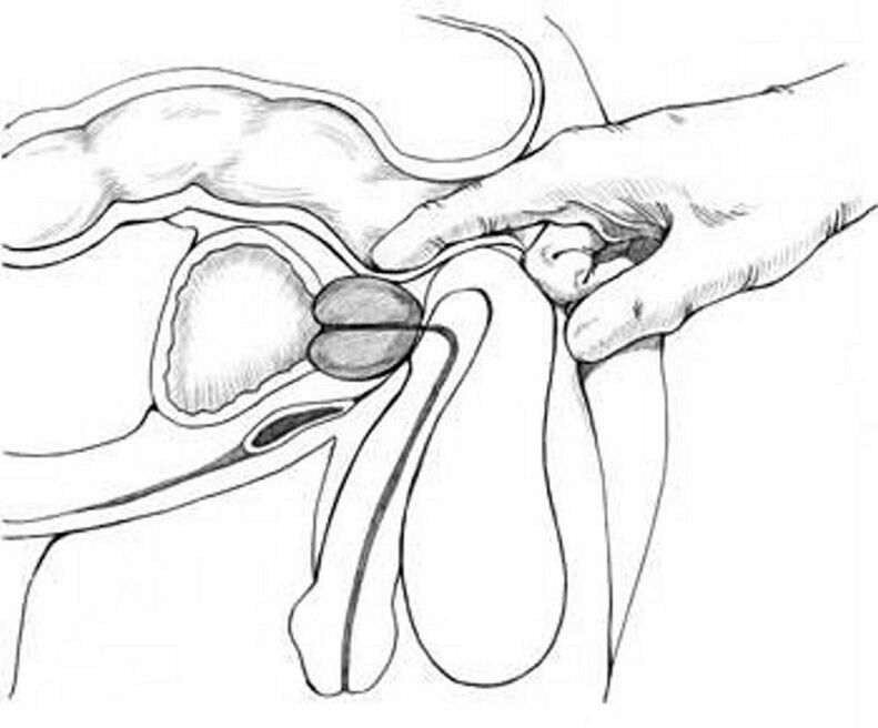 Prostate massage for treatment of chronic prostatitis