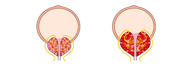 Healthy and inflamed prostate with prostatitis