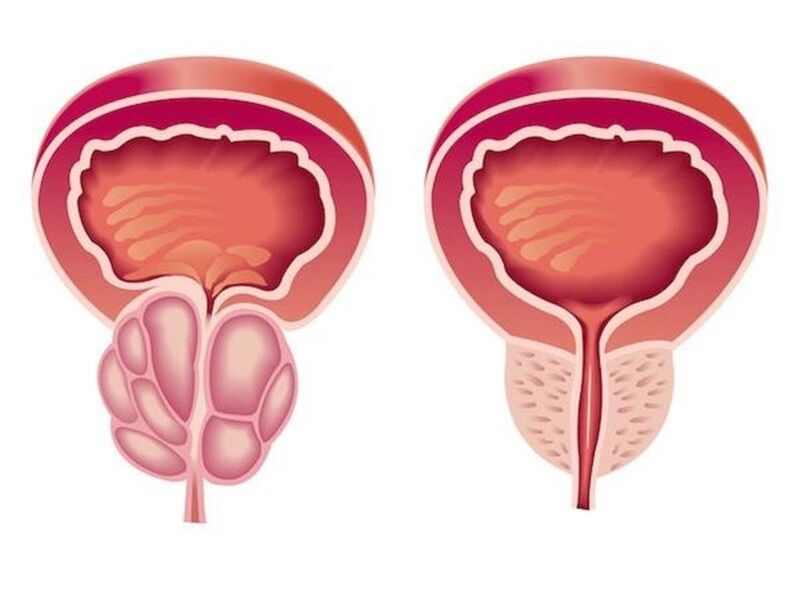 prostatitis