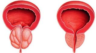 the difference in the sick and healthy of the prostate