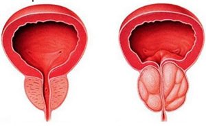 the prostate